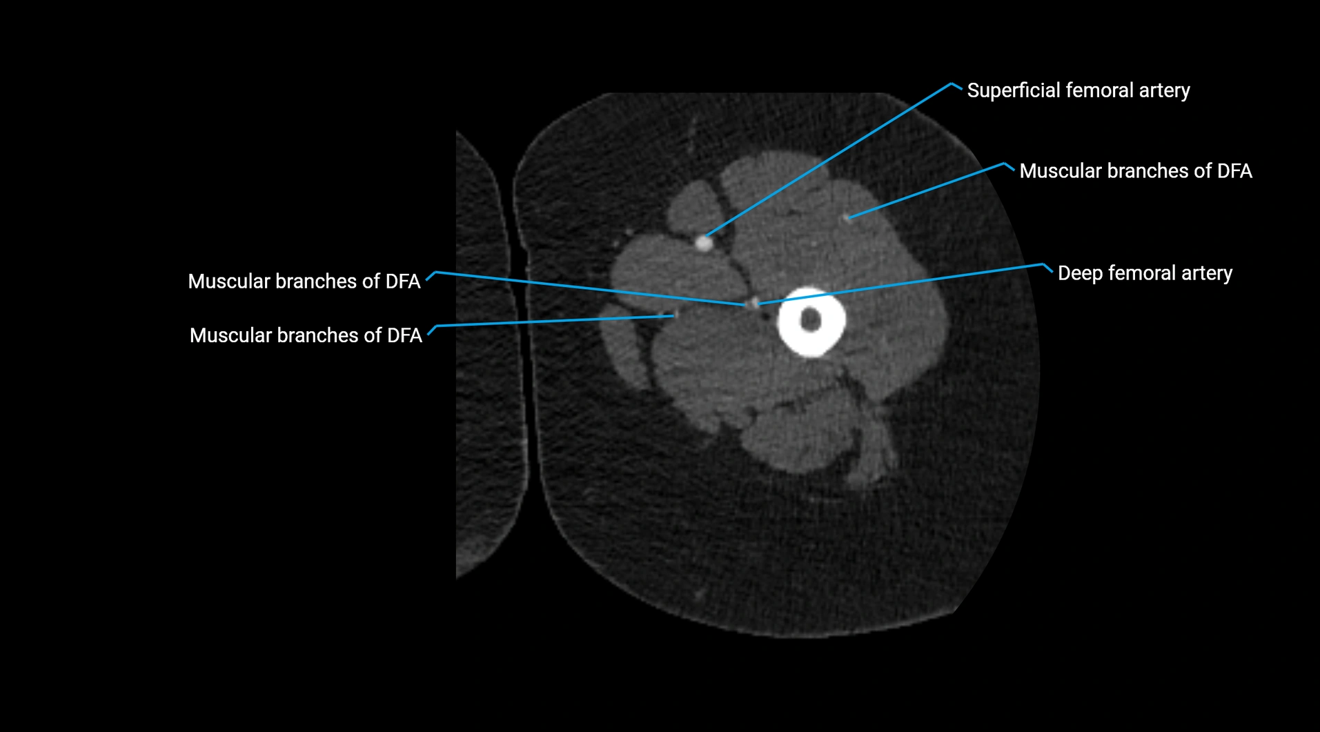 CTA lower limb cross sectional anatomy labelled image _103.webp